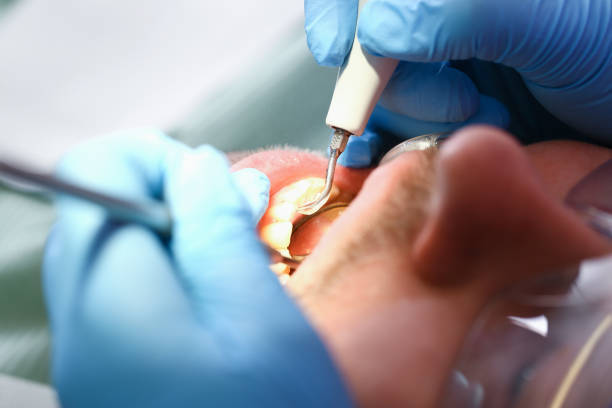 Best Emergency Wisdom Tooth Extraction in Temecula, CA